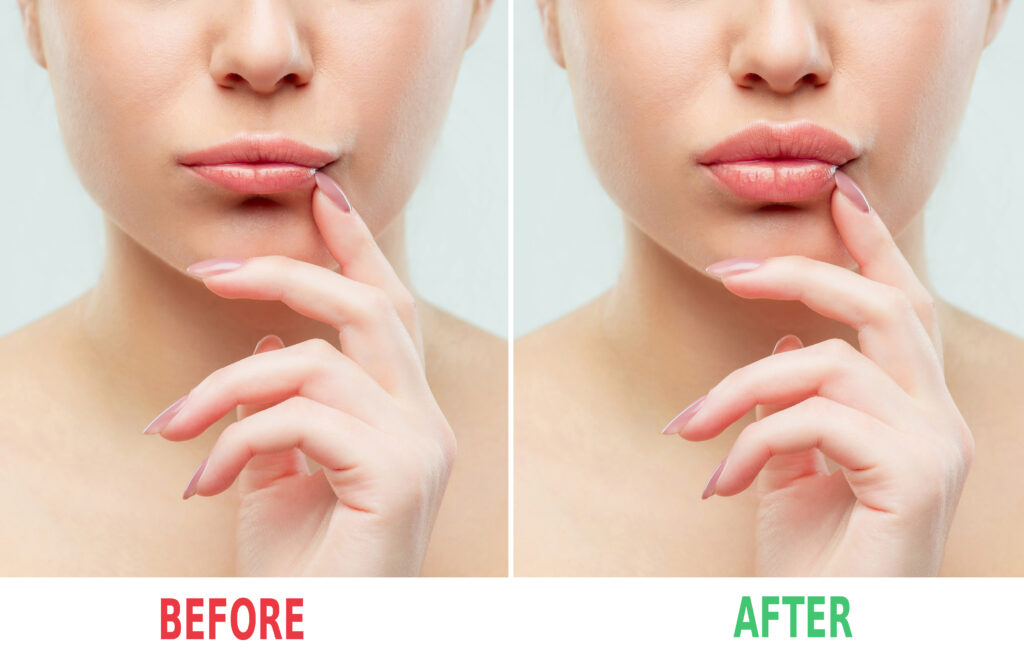 Εμφυτεύματα (fillers – υαλουρονικό οξύ)