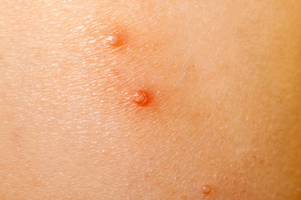Infectious Terebinth (Skin Infection)