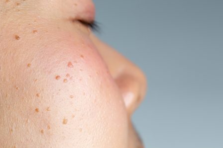 Seborrheic,Keratosis,,Pore,,Acne,And,Wrinkles,In,Face,Woman,Skin.
