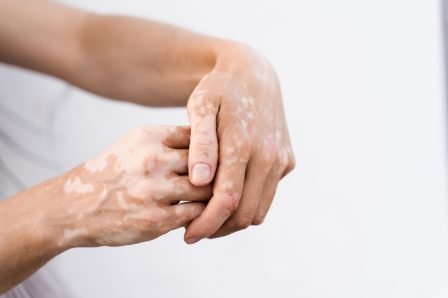 Hands,With,Vitiligo,Skin,Pigmentation,On,White,Background,Close-up.,Lifestyle Hands,With,Vitiligo,Skin,Pigmentation,On,White,Background,Close-up.,Lifestyle